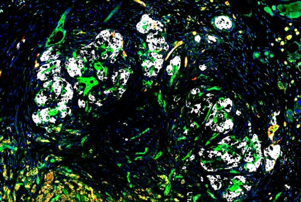 Cell Therapy Cures Type 1 Diabetes in Mice